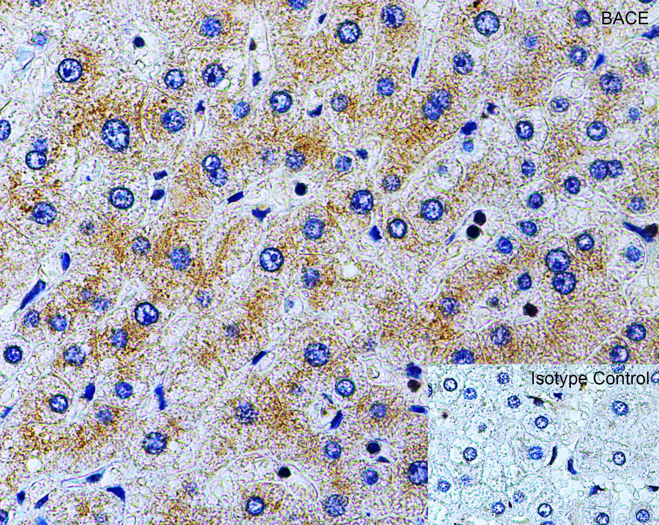 <strong>Figure 4 Immunohistochemistry Validation of BACE in Human Liver</strong><br>
Immunohistochemical analysis of paraffin-embedded human liver tissue using anti-BACE antibody (2253) at 2 μg/ml. Tissue was fixed with formaldehyde and blocked with 10% serum for 1 h at RT; antigen retrieval was by heat mediation with a citrate buffer (pH6). Samples were incubated with primary antibody overnight at 4˚C. A goat anti-rabbit IgG H&L (HRP) at 1/250 was used as secondary. Counter stained with Hematoxylin. <strong>Figure 4 Immunohistochemistry Validation of BACE in Human Liver</strong><br>
Immunohistochemical analysis of paraffin-embedded human liver tissue using anti-BACE antibody (2253) at 2 μg/ml. Tissue was fixed with formaldehyde and blocked with 10% serum for 1 h at RT; antigen retrieval was by heat mediation with a citrate buffer (pH6). Samples were incubated with primary antibody overnight at 4˚C. A goat anti-rabbit IgG H&L (HRP) at 1/250 was used as secondary. Counter stained with Hematoxylin.