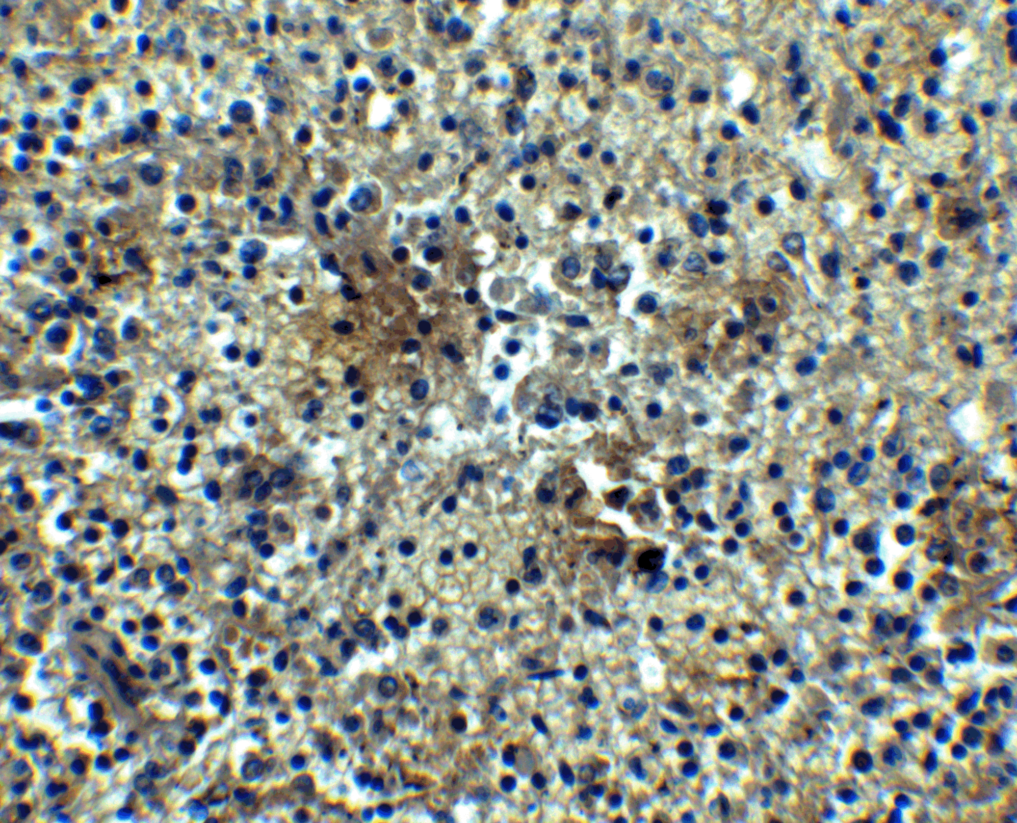 Immunohistochemistry of BAFF-R in human spleen tissue with BAFF-R antibody at 5 μg/mL. Immunohistochemistry of BAFF-R in human spleen tissue with BAFF-R antibody at 5 μg/mL.