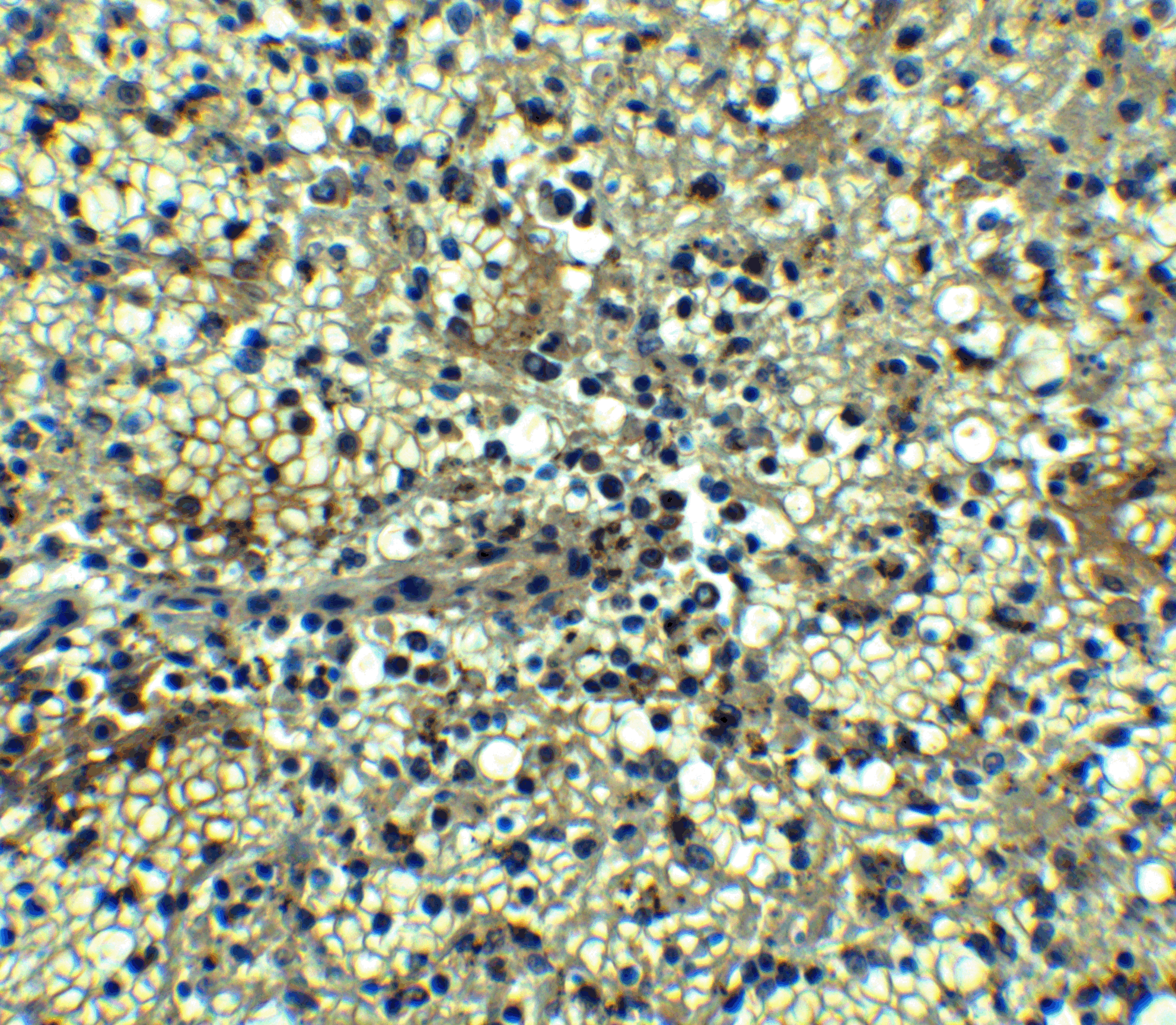 <strong>Figure 4  Immunohistochemistry Validation of BCMA in Human Spleen</strong><br>  
Immunohistochemical analysis of paraffin-embedded human spleen tissue using anti-BCMA antibody (2397) at 5 μg/ml. Tissue was fixed with formaldehyde and blocked with 10% serum for 1 h at RT; antigen retrieval was by heat mediation with a citrate buffer (pH6). Samples were incubated with primary antibody overnight at 4˚C. A goat anti-rabbit IgG H&L (HRP) at 1/250 was used as secondary. Counter stained with Hematoxylin.