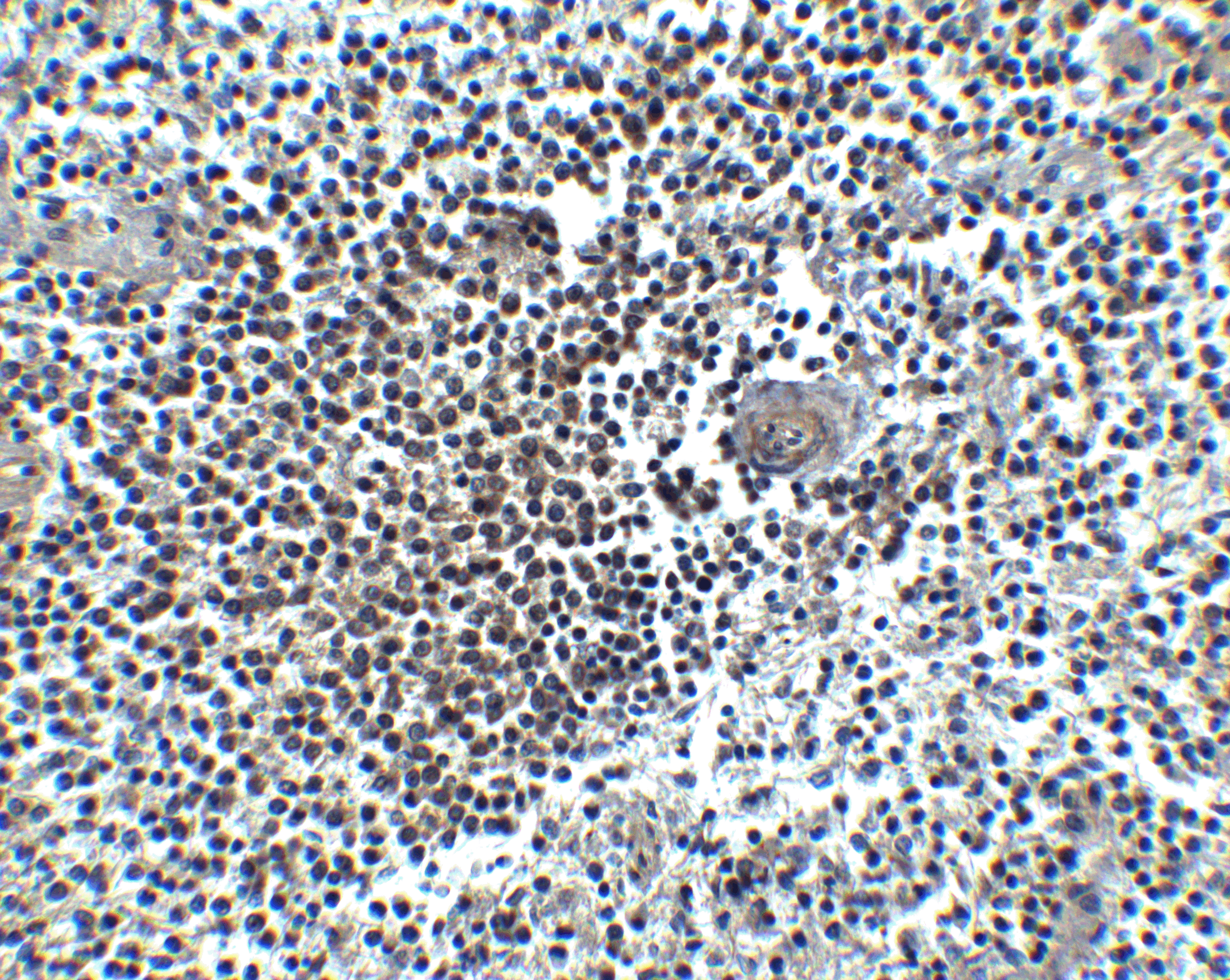<strong>Figure 8 Immunohistochemistry Validation of CXCR4 in Human Spleen</strong><br> Immunohistochemical analysis of paraffin-embedded human spleen tissue using anti-CXCR4 antibody (1009) at 5 μg/ml. Tissue was fixed with formaldehyde and blocked with 10% serum for 1 h at RT; antigen retrieval was by heat mediation with a citrate buffer (pH6). Samples were incubated with primary antibody overnight at 4˚C. A Goat anti-rabbit IgG H&L (HRP) at 1/250 was used as secondary. Counter stained with Hematoxylin. <strong>Figure 8 Immunohistochemistry Validation of CXCR4 in Human Spleen</strong><br> Immunohistochemical analysis of paraffin-embedded human spleen tissue using anti-CXCR4 antibody (1009) at 5 μg/ml. Tissue was fixed with formaldehyde and blocked with 10% serum for 1 h at RT; antigen retrieval was by heat mediation with a citrate buffer (pH6). Samples were incubated with primary antibody overnight at 4˚C. A Goat anti-rabbit IgG H&L (HRP) at 1/250 was used as secondary. Counter stained with Hematoxylin.