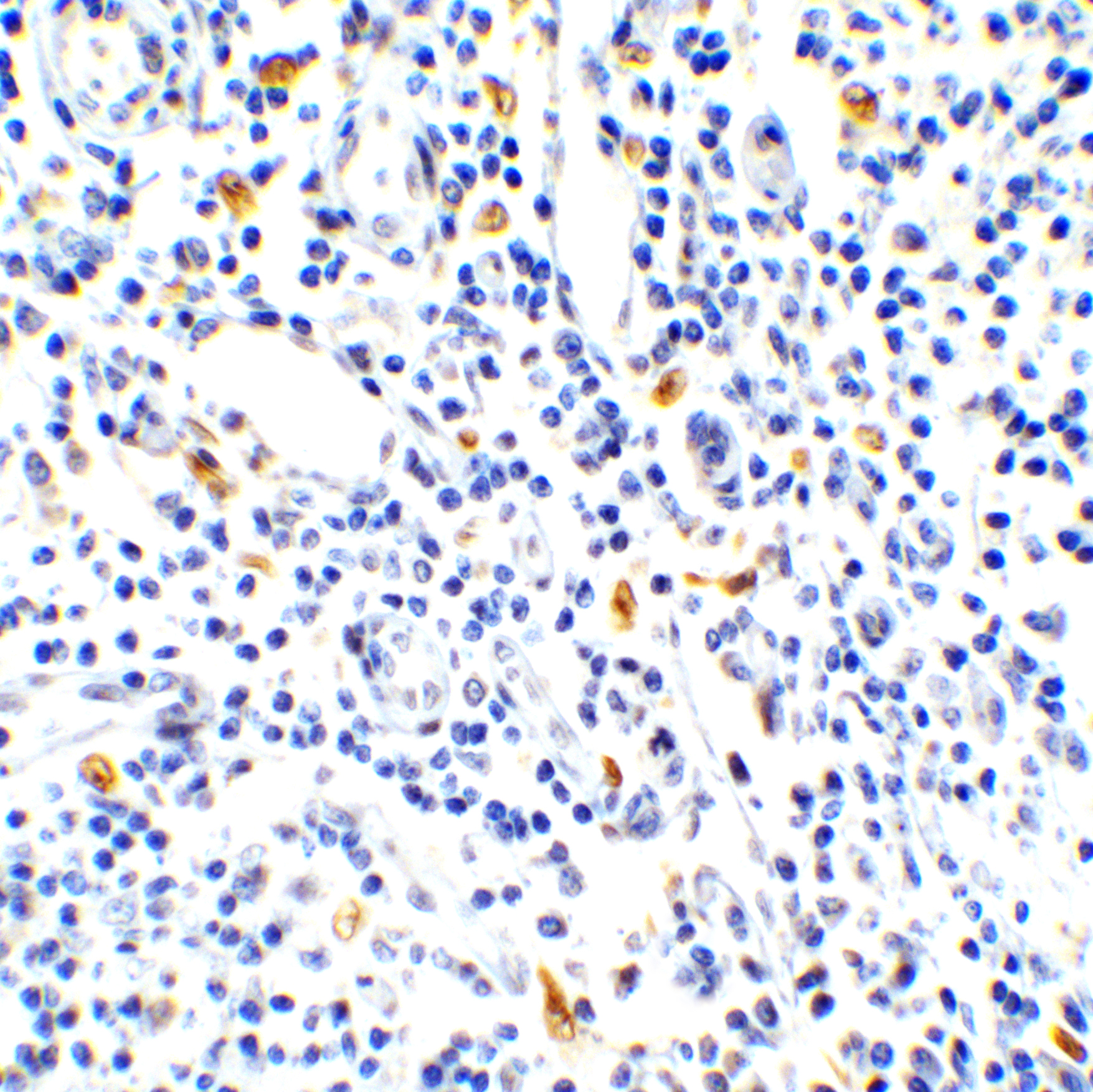 <strong>Figure 3 Immunohistochemistry Validation of IL-17 in Human Lymph Node </strong><br>
Immunohistochemical analysis of paraffin-embedded human lymph node tissue using anti-IL-17 antibody (4887) at 1 μg/ml. Tissue was fixed with formaldehyde and blocked with 10% serum for 1 h at RT; antigen retrieval was by heat mediation with a citrate buffer (pH6). Samples were incubated with primary antibody overnight at 4˚C. A goat anti-rabbit IgG H&L (HRP) at 1/250 was used as secondary. Counter stained with Hematoxylin. <strong>Figure 3 Immunohistochemistry Validation of IL-17 in Human Lymph Node </strong><br>
Immunohistochemical analysis of paraffin-embedded human lymph node tissue using anti-IL-17 antibody (4887) at 1 μg/ml. Tissue was fixed with formaldehyde and blocked with 10% serum for 1 h at RT; antigen retrieval was by heat mediation with a citrate buffer (pH6). Samples were incubated with primary antibody overnight at 4˚C. A goat anti-rabbit IgG H&L (HRP) at 1/250 was used as secondary. Counter stained with Hematoxylin.