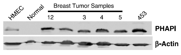 <strong>Figure 7 Increased Expression Validation of PHAPI in Patient Samples of Breast
Tumor Tissue (Schafer et al., 2006) </strong><br>
PHAPI was overexpressed in all breast tumor samples of patients and human breast cancer cells (MDA-MB-453), but not in the normal breast tissue or human primary mammary epithelial cells (HMEC). <strong>Figure 7 Increased Expression Validation of PHAPI in Patient Samples of Breast
Tumor Tissue (Schafer et al., 2006) </strong><br>
PHAPI was overexpressed in all breast tumor samples of patients and human breast cancer cells (MDA-MB-453), but not in the normal breast tissue or human primary mammary epithelial cells (HMEC).