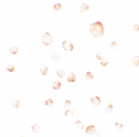 Immunocytochemistry of PHLPP1 in SW480 cells with PHLPP1 antibody at 2.5 μg/ml. Immunocytochemistry of PHLPP1 in SW480 cells with PHLPP1 antibody at 2.5 μg/ml.