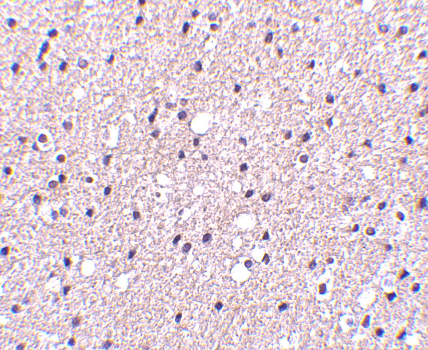 Immunohistochemistry of Presenilin1 in human brain tissue with Presenilin1 antibody at 2.5 μg/mL. Immunohistochemistry of Presenilin1 in human brain tissue with Presenilin1 antibody at 2.5 μg/mL.