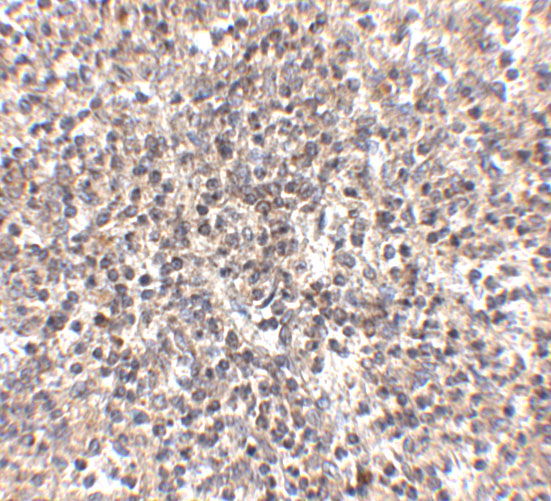 <strong>Figure 8 Immunohistochemistry Validation of RSPO1 in Human Spleen Tissue </strong><br>
Immunohistochemical analysis of paraffin-embedded human spleen tissue using anti-RSPO1 antibody (5171) at 2.5 ug/ml. Tissue was fixed with formaldehyde and blocked with 10% serum for 1 h at RT; antigen retrieval was by heat mediation with a citrate buffer (pH6). Samples were incubated with primary antibody overnight at 4˚C. A goat anti-rabbit IgG H&L (HRP) at 1/250 was used as secondary. Counter stained with Hematoxylin. <strong>Figure 8 Immunohistochemistry Validation of RSPO1 in Human Spleen Tissue </strong><br>
Immunohistochemical analysis of paraffin-embedded human spleen tissue using anti-RSPO1 antibody (5171) at 2.5 ug/ml. Tissue was fixed with formaldehyde and blocked with 10% serum for 1 h at RT; antigen retrieval was by heat mediation with a citrate buffer (pH6). Samples were incubated with primary antibody overnight at 4˚C. A goat anti-rabbit IgG H&L (HRP) at 1/250 was used as secondary. Counter stained with Hematoxylin.
