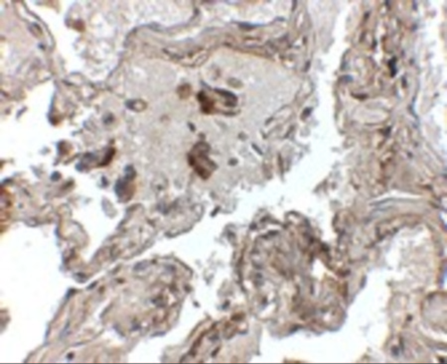 Immunohistochemistry of Transthyretin in human lung tissue with Transthyretin antibody at 2.5 μg/mL. Immunohistochemistry of Transthyretin in human lung tissue with Transthyretin antibody at 2.5 μg/mL.