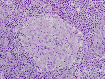Granuloma Causes